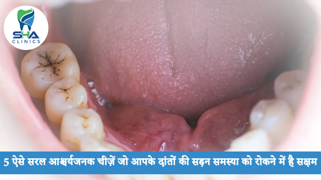 5 ऐसे सरल आश्चर्यजनक चीज़ें जो आपके दांतों की सड़न समस्या को रोकने में है सक्षम