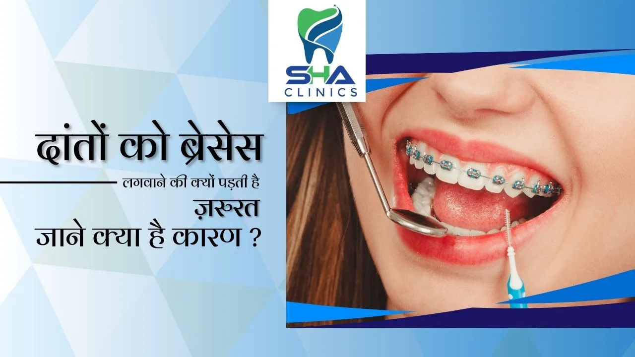 जाने किन कारणों से दांतों में ब्रेसेस लगवानी की पड़ती है ज़रुरत ?