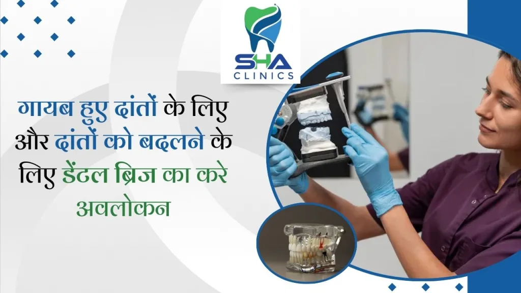 डेंटल ब्रिज: गायब हुए दांतों को बदलने और मुस्कान को बहाल करने का समाधान