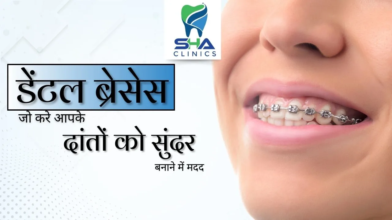 डेंटल ब्रेसेस: सुंदर दांत पाने के लिए एक आसान और प्रभावी तरीका