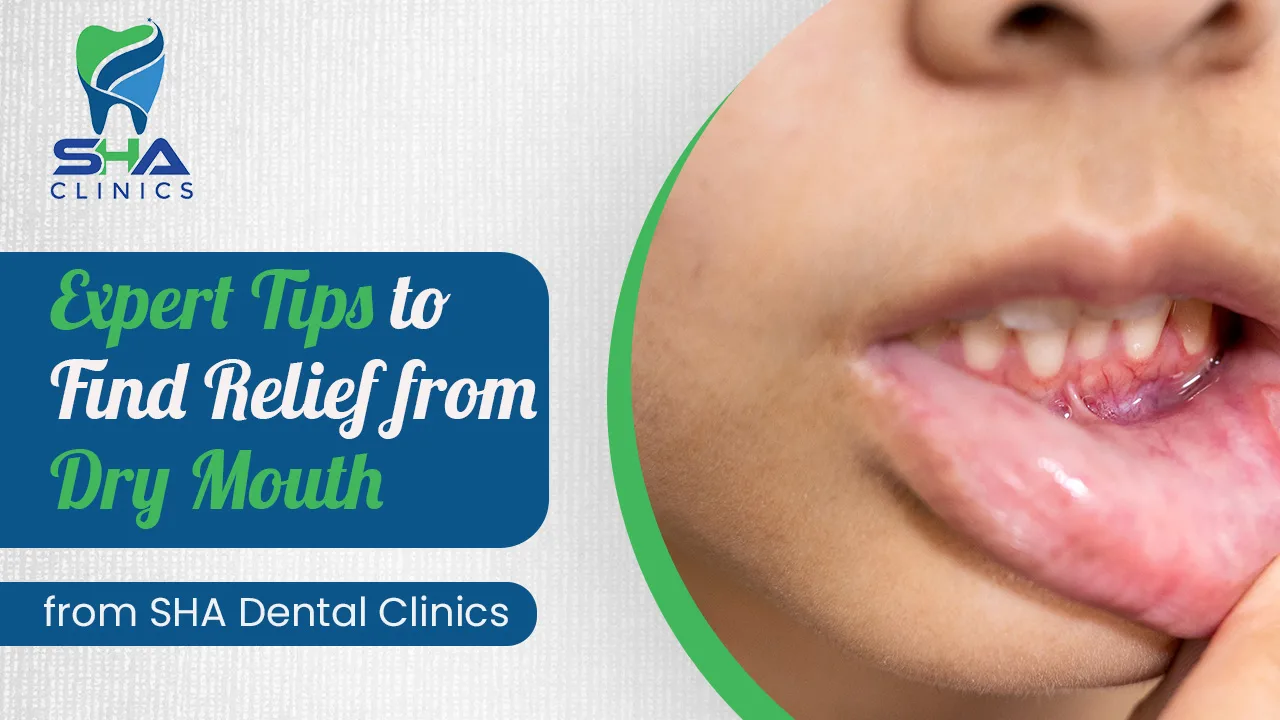 Dry Mouth Solutions: Expert Tips from SHA Dental Clinics